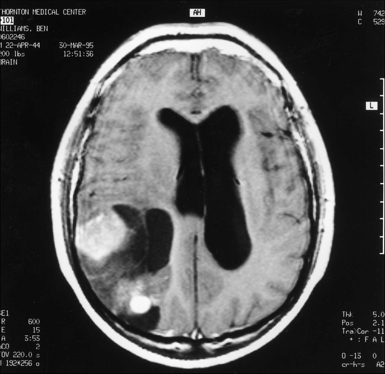 2 pav. MRT pjūvis per smegenų vidurį tarp viršaus ir apačios, rodantis naviką