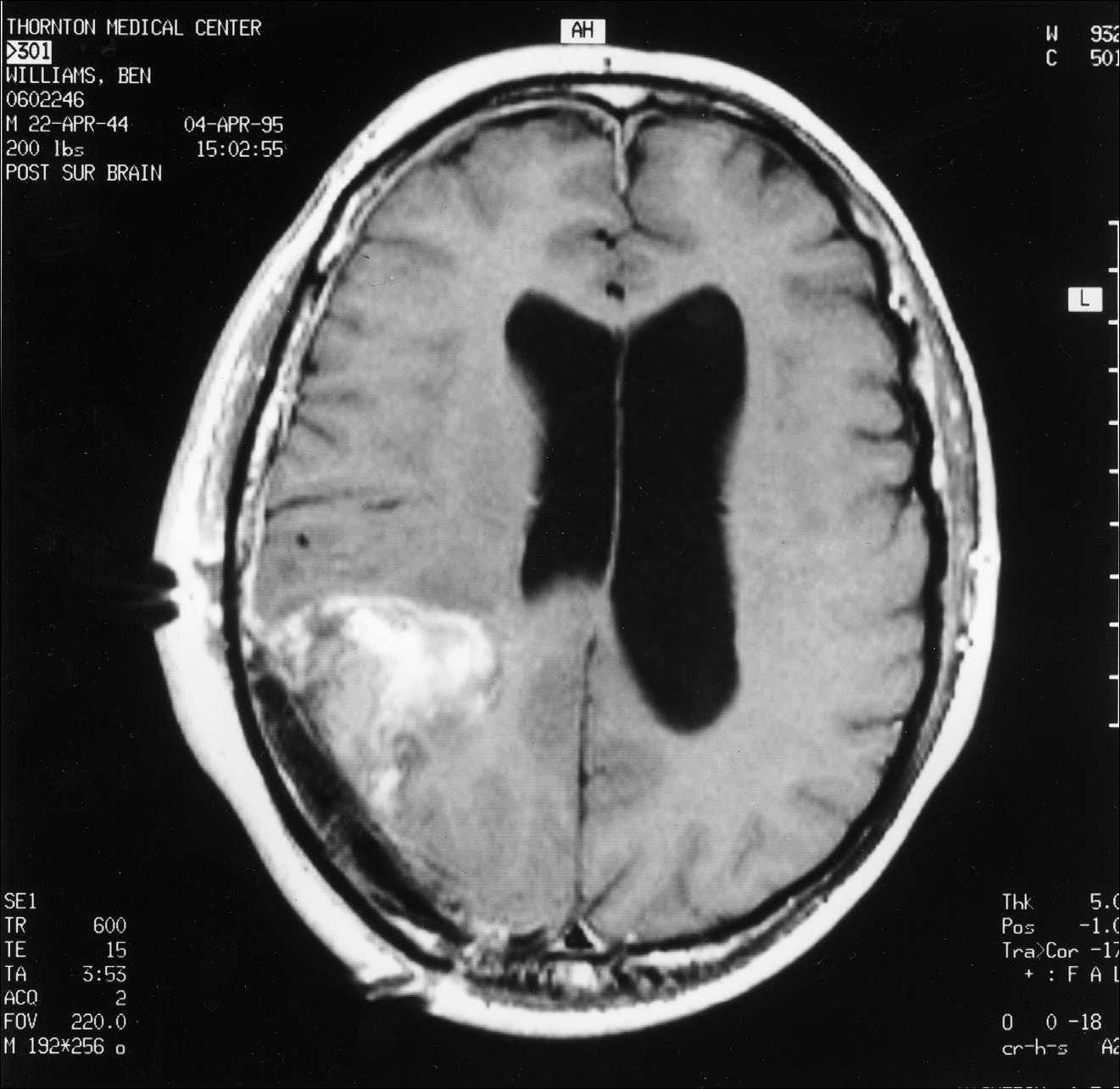 4 pav. Pooperacinis MRT pjūvis tarp viršaus ir apačios — po operacijos liko nemaža naviko dalis
